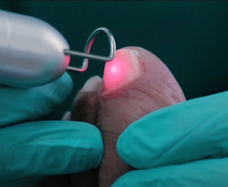 hongos-unas-laser-podologia-sant-boi
